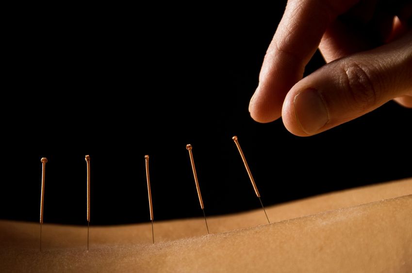 La médecine traditionnelle chinoise et l’acupuncture